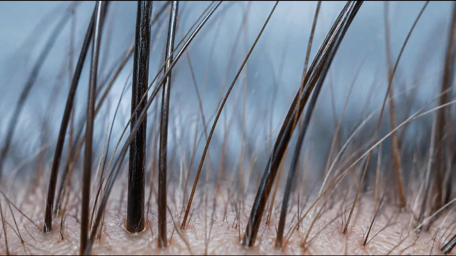 Close-up of scalp skin with thick dark hairs growing beside fine, thinner miniaturized hairs